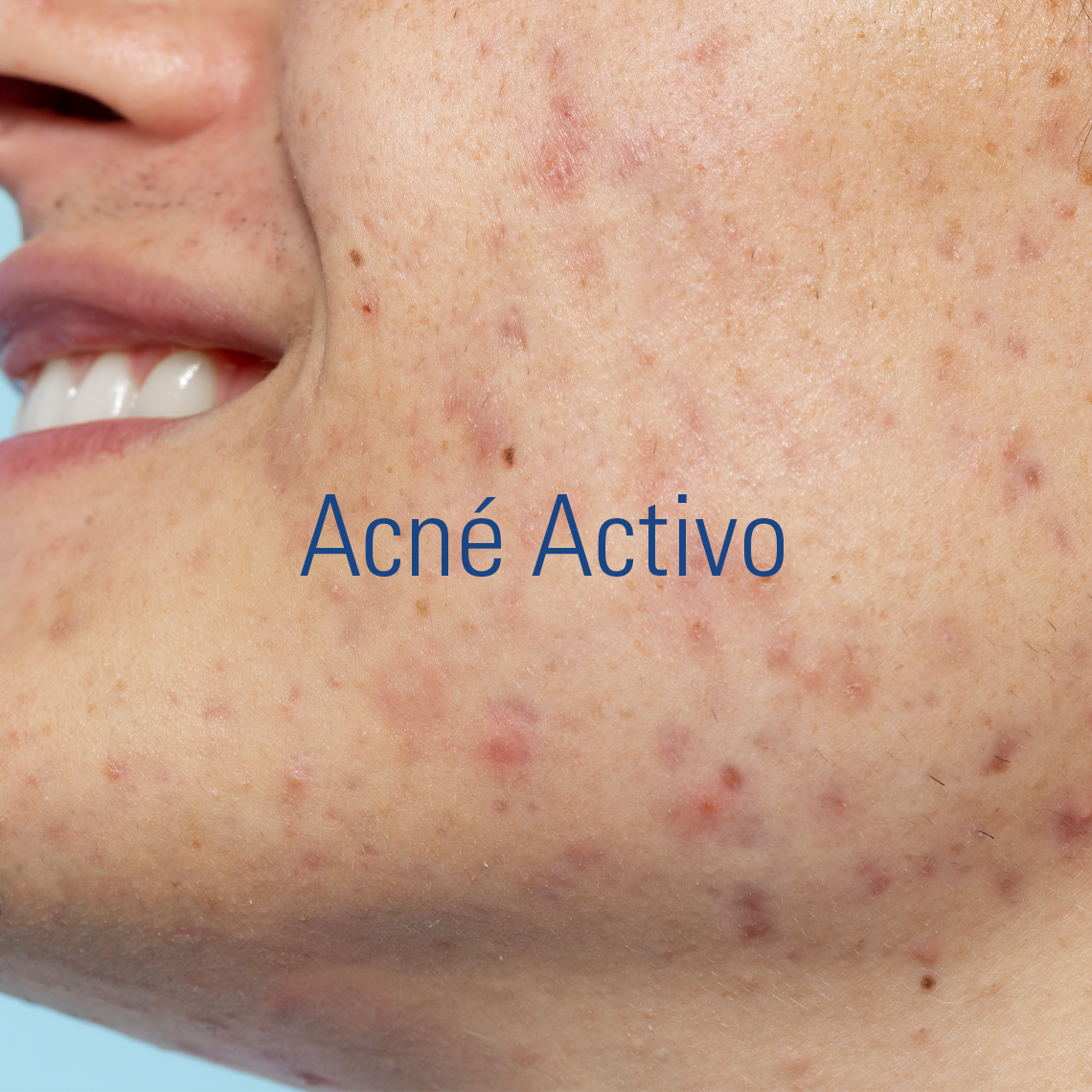 Acné Activo
